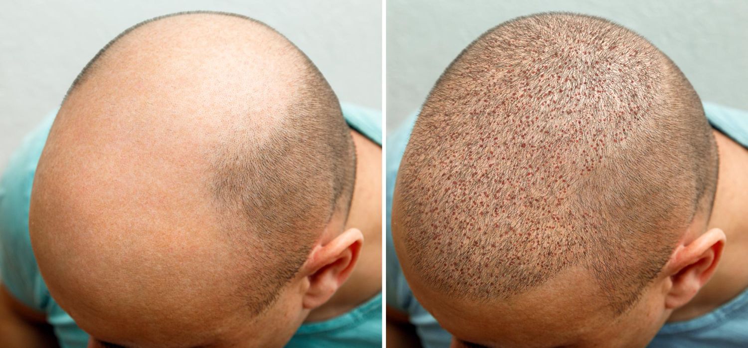 Hair Transplant Surgery