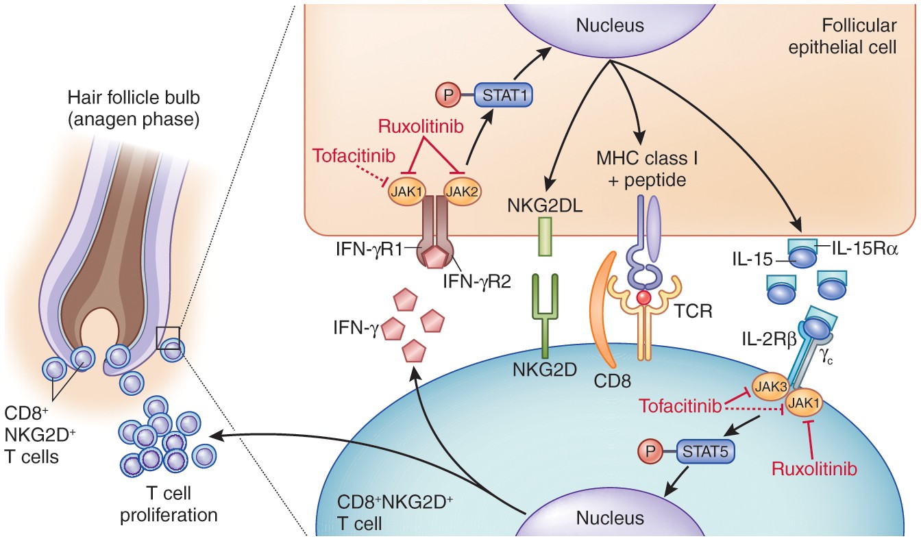 JAK Inhibitors for Alopecia Areata