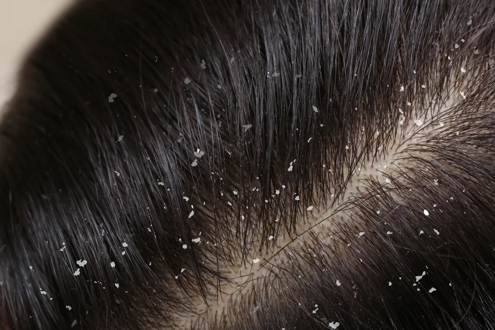 dandruff triggered by pollution