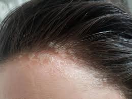 Sunburn on the scalp